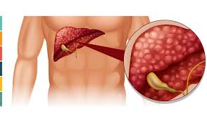 Pankreas Kanseri - Tıbbi Görsel